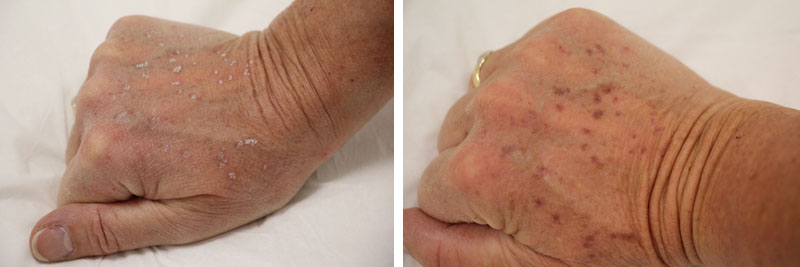 Photo de traitement des taches pigmentaires au laser sur les mains juste après le traitement et le lendemain du traitement